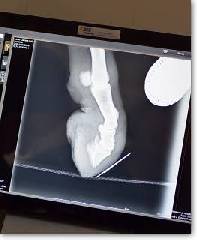 X-Ray of foot